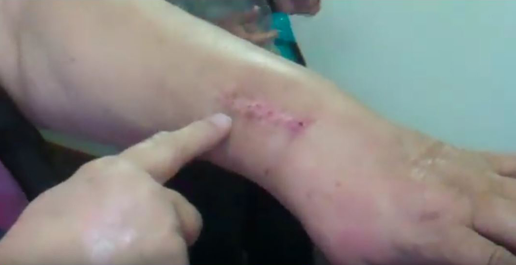 God Heals Fused Wrist